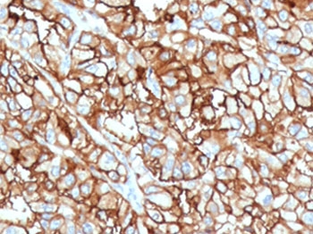 IHC staining of FFPE human renal cell carcinoma with CD10 antibody (clone CDLA10-1). Required HEIR: boil tissue sections in 10mM Tris with 1mM EDTA, pH 9, for 10-20 min and allow to cool before testing.~