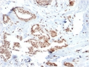 IHC testing of FFPE human breast carcinoma with SOX4 antibody (clone SOX4/2540). HIER: boil tissue sections in pH6, 10mM citrate buffer for 10-20 min and allow to cool before testing.