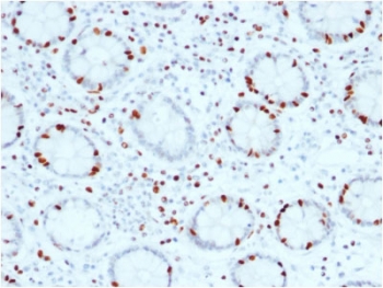 IHC testing of FFPE human colon carcinoma with SOX4 antibody (clone SOX4/2540). HIER: boil tissue sections in pH6, 10mM citrate buffer for 10-20 min and allow to cool before testing.~
