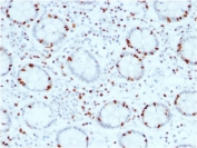 IHC testing of FFPE human colon carcinoma with SOX4 antibody (clone SOX4/2540). HIER: boil tissue sections in pH6, 10mM citrate buffer for 10-20 min and allow to cool before testing.