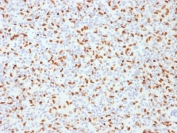 IHC staining of FFPE Hodgkin's lymphoma with PU.1 antibody (clone PU1/2146). HIER: boil tissue sections in pH 9 10mM Tris with 1mM EDTA for 10-20 min followed by cooling at RT for 20 min.