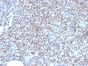 IHC staining of FFPE human lymph node with PU.1 antibody (clone PU1/2146). HIER: boil tissue sections in pH 9 10mM Tris with 1mM EDTA for 10-20 min followed by cooling at RT for 20 min.