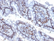 IHC staining of FFPE human colon carcinoma with PU.1 antibody (clone PU1/2146). HIER: boil tissue sections in pH 9 10mM Tris with 1mM EDTA for 10-20 min followed by cooling at RT for 20 min.