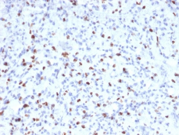 IHC staining of FFPE human rhabdomyosarcoma with Myogenin antibody (clone MYOG/2660). HIER: boil tissue sections in pH6, 10mM citrate buffer, for 10-20 min followed by cooling at RT for 20 min.~