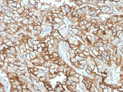 IHC staining of FFPE human renal cell carcinoma with CD10 antibody (clone MME/1870). Required HEIR: boil tissue sections in 10mM Tris with 1mM EDTA, pH 9, for 10-20 min and allow to cool before testing.