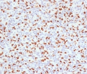 IHC staining of FFPE human Hodgkin's lymphoma with PU.1 antibody (clone TFPU1-1). HIER: boil tissue sections in pH 9 10mM Tris with 1mM EDTA for 10-20 min followed by cooling at RT for 20 min.