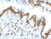 IHC testing of FFPE human endometrial carcinoma with TLE1 antibody (clone TLEP1-1). Required HIER: boil tissue sections in pH 9 10mM Tris with 1mM EDTA for 10-20 min followed by cooling at RT for 20 min.