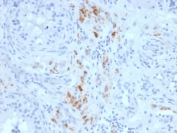 IHC staining of FFPE human testicular carcinoma with StAR antibody (clone STAR/2140). Required HIER: boil tissue sections in 10mM citrate buffer, pH 6, for 10-20 min followed by cooling at RT for 20 min.