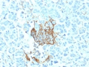 IHC testing of FFPE human breast carcinoma with NGF Receptor antibody (clone NGFR/1964). HIER: boil tissue sections in pH6, 10mM citrate buffer, for 10-20 min followed by cooling at RT for 20 min.