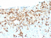 IHC testing of FFPE human melanoma tissue with NGF Receptor antibody (clone NGFR/1964). HIER: boil tissue sections in pH6, 10mM citrate buffer, for 10-20 min followed by cooling at RT for 20 min.