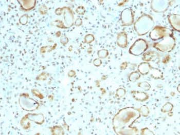 IHC staining of FFPE human renal cell carcinoma with STAT3 antibody (clone STAT6/2410). HIER: boil tissue sections in pH6, 10mM citrate buffer, for 10-20 min followed by cooling at RT for 20 min.