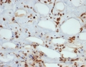 IHC staining of FFPE human liposarcoma tissue with STAT3 antibody (clone STAT6/2410). HIER: boil tissue sections in pH6, 10mM citrate buffer, for 10-20 min followed by cooling at RT for 20 min.