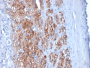 IHC staining of FFPE human testicular carcinoma with StAR antibody (clone STAR/2154). Required HIER: boil tissue sections in pH 9 10mM Tris with 1mM EDTA for 10-20 min followed by cooling at RT for 20 min.