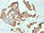 IHC testing of human colon carcinoma with Cytokeratin 20 antibody (clone KRT20/1992). Required HIER: boil tissue sections in 10mM citrate buffer, pH 6, for 10-20 min followed by cooling at RT for 20 min.