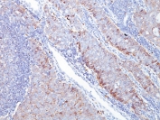 IHC testing of human breast carcinoma with GLUT1 antibody (clone GLUT1/2476). Required HIER: boil tissue sections in pH 9 10mM Tris with 1mM EDTA for 10-20 min followed by cooling at RT for 20 min.
