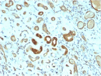 IHC staining of FFPE human renal cell carcinoma with STAT3 antibody (clone STAT3/2409). HIER: boil tissue sections in pH6, 10mM citrate buffer, for 10-20 min followed by cooling at RT for 20 min.~