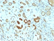 IHC staining of FFPE human renal cell carcinoma with STAT3 antibody (clone STAT3/2409). HIER: boil tissue sections in pH6, 10mM citrate buffer, for 10-20 min followed by cooling at RT for 20 min.