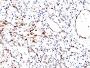 IHC testing of human renal cell carcinoma with PTEN antibody (clone PTEN/2110). Required HIER: boil tissue sections in 10mM citrate buffer, pH 6, for 10-20 min followed by cooling at RT for 20 min.