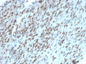 IHC testing of FFPE human GIST with TLE1 antibody (clone TLE1/2062). Required HIER: boil tissue sections in pH 9 10mM Tris with 1mM EDTA for 10-20 min followed by cooling at RT for 20 min.