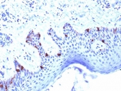 IHC testing of human skin with Melanoma gp100 antibody (clone PMEL/2039). Required HIER: boil tissue sections in 10mM citrate buffer, pH 6, for 10-20 min followed by cooling at RT for 20 min.