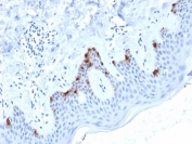 IHC testing of human skin with Melanoma gp100 antibody (clone PMEL/2038). Required HIER: boil tissue sections in pH 9 10mM Tris with 1mM EDTA for 10-20 min followed by cooling at RT for 20 min.