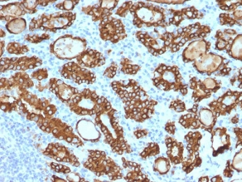 IHC testing of FFPE human thyroid carcinoma stained with Thyroid Peroxidase antibody (clone TPO/1922). Required HIER: boil tissue sections in 10mM citrate buffer, pH 6, for 10-20 min followed by cooling at RT for 20 min.~