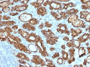 IHC testing of FFPE human thyroid carcinoma stained with Thyroid Peroxidase antibody (clone TPO/1922). Required HIER: boil tissue sections in 10mM citrate buffer, pH 6, for 10-20 min followed by cooling at RT for 20 min.
