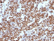 IHC staining of FFPE human melanoma with Vimentin antibody (clone VM452). HIER: boil tissue sections in pH 9 10mM Tris with 1mM EDTA for 10-20 min followed by cooling at RT for 20 min.