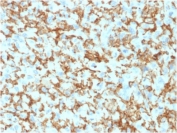 IHC testing of FFPE human histiocytoma with CD163 antibody (clone M130/1210). HIER: boil tissue sections in pH6, 10mM citrate buffer, for 10-20 min followed by cooling at RT for 20 min.