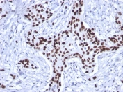 IHC testing of FFPE human breast carcinoma stained with recombinant p53 antibody (clone rTP53/1739). Required HIER: boil tissue sections in 10mM Citrate buffer, pH 6.0, for 10-20 min followed by cooling at RT for 20 min.