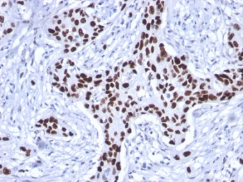 IHC testing of FFPE human breast carcinoma stained with recombinant p53 antibody (clone rTP53/1739). R