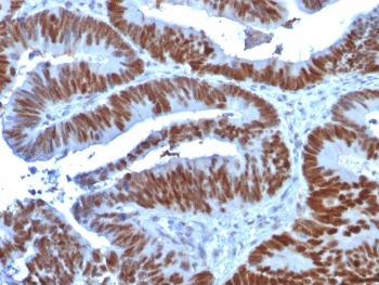 IHC testing of FFPE human colon carcinoma stained with p53 antibody (clone TP53/1739). Required HIER: boil tissue sections in 10mM Citrate buffer, pH 6.0, for 10-20 min followed by cooling at RT for 20 min.~