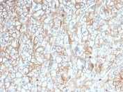 IHC testing of FFPE lung SCC with PD-L1 antibody (clone PDL1/2746). HIER: boil tissue sections in pH 9 10mM Tris with 1mM EDTA for 10-20 min followed by cooling at RT for 20 min.