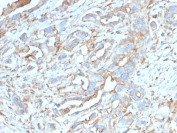 IHC testing of FFPE breast carcinoma with PD-L1 antibody (clone PDL1/2746). HIER: boil tissue sections in pH 9 10mM Tris with 1mM EDTA for 10-20 min followed by cooling at RT for 20 min.