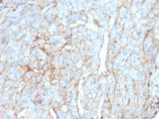IHC testing of FFPE cervical carcinoma with PD-L1 antibody (clone PDL1/2746). HIER: boil tissue sections in pH 9 10mM Tris with 1mM EDTA for 10-20 min followed by cooling at RT for 20 min.