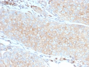 IHC testing of FFPE basal cell carcinoma with PD-L1 antibody (clone PDL1/2746). HIER: boil tissue sections in pH 9 10mM Tris with 1mM EDTA for 10-20 min followed by cooling at RT for 20 min.