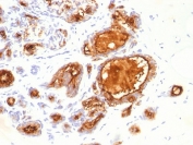 IHC testing of FFPE human breast carcinoma with MUC1 antibody (clone 115D8). HIER: requires steaming of sections in pH 9 10mM Tris with 1mM EDTA for 10-20 min.