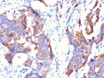 IHC testing of FFPE human stomach with MUC1 antibody (clone 115D8). HIER: requires steaming of sections in pH 9 10mM Tris with 1mM EDTA for 10-20 min.~