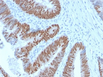 IHC testing of FFPE human colon carcinoma with recombinant CDX2 antibody (clone CDX2/2951R). HIER: boil tissue sections in 10mM Tris with 1mM EDTA, pH 9, for 10-20 min followed by cooling prior to testing.~