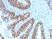 IHC testing of FFPE human colon carcinoma with recombinant CDX2 antibody (clone CDX2/2951R). HIER: boil tissue sections in 10mM Tris with 1mM EDTA, pH 9, for 10-20 min followed by cooling prior to testing.
