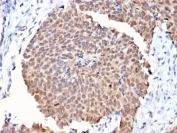 IHC testing of FFPE human breast cancer with FAF1 antibody. HIER: boiling tissue sections in 10mM citrate buffer, pH 6, for 10-20 min and allow to cool prior to staining.