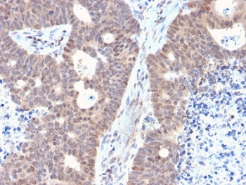 IHC testing of FFPE human colon carcinoma with FAF1 antibody. HIER: boiling tissue sections in 10mM citrate buffer, pH 6, for 10-20 min and allow to cool prior to staining.~