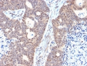 IHC testing of FFPE human colon carcinoma with FAF1 antibody. HIER: boiling tissue sections in 10mM citrate buffer, pH 6, for 10-20 min and allow to cool prior to staining.