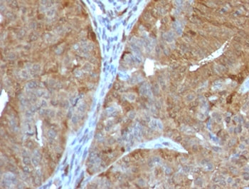 IHC testing of FFPE human prostate cancer with AKR1B1 antibody (clone ADRD1-1). Required HIER: boil tissue sections in 10mM citrate buffer, pH6, for 10-20 min followed by cooling at RT for 20 min.~