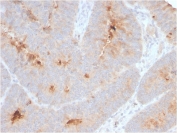 IHC staining of FFPE human colon carcinoma with recombinant ECM1 antibody (clone ECM1/792). HIER: boil tissue sections in pH 9 10mM Tris with 1mM EDTA for 10-20 min and allow to cool before testing.
