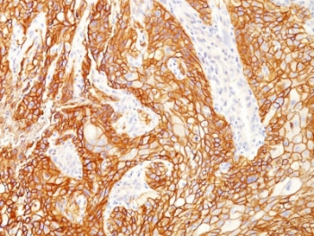 IHC testing of FFPE human lung squamous cell carcinoma with recombinant EGFRvIII antibody (clone GFR/2600R). Required HIER: boiling tissue sections in pH 9 10mM Tris with 1mM EDTA for 10-20 min and allow to cool prior to testing.~