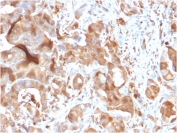 IHC testing of FFPE human hepatic carcinoma with FABP5 antibody. HIER: boiling tissue sections in pH 9 10mM Tris with 1mM EDTA for 10-20 min and allow to cool prior to staining.