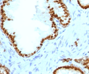 IHC staining of FFPE human prostate carcinoma with recombinant ATRX antibody (clone ATMRX-1R). HIER: boil tissue sections in 10mM Tris with 1mM EDTA buffer, pH 9, for 10-20 min followed by cooling at RT for 20 min.~