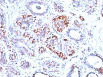 IHC testing of FFPE human breast carcinoma with GATA3 antibody. Required HIER: boil tissue sections in 10mM citrate buffer, pH 6, for 10-20 min and allow to cool prior to testing.