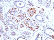 IHC testing of FFPE human breast carcinoma with GATA3 antibody (clone GATA3/2442). Required HIER: boil tissue sections in 10mM citrate buffer, pH 6, for 10-20 min and allow to cool prior to testing.